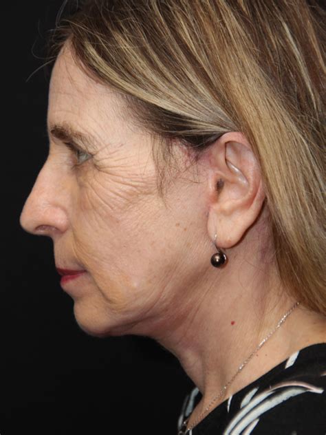 Patient Facelift Solomon Facial Plastic