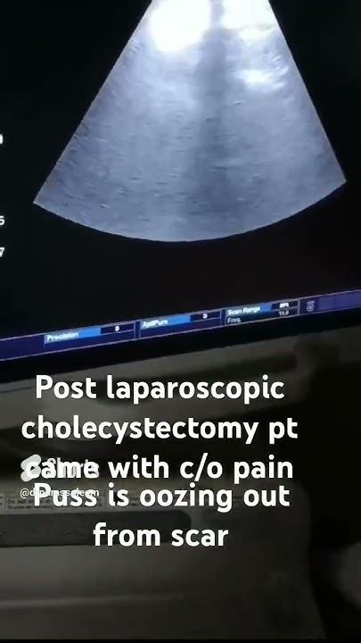 Post Laparoscopic Cholecystectomy Ultrasound Showing Puss Oozing Out At The Site Of Scar Youtube