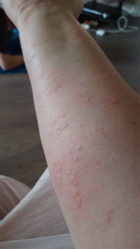 Can Humans Get A Rash From Dogs