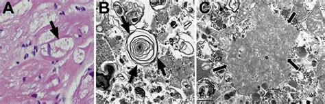 Endomyocardial Biopsy Light Microscopy Demonstrates A Prominent