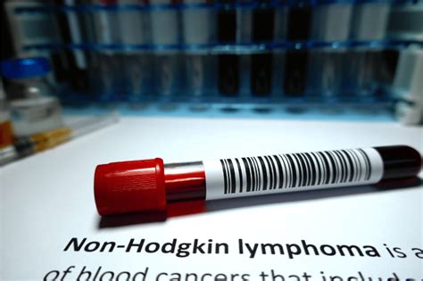 Signs and Symptoms of Lymphoma