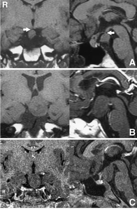 A A 7 Year Old Girl With Precocious Puberty Coronal Left And