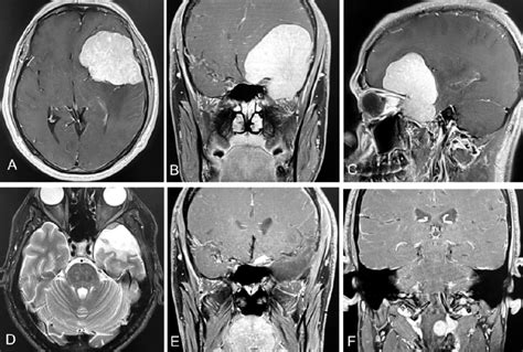 A Preoperative Axial T1 Weighted Image A Coronal B Sagittal C