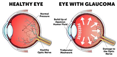 Eye Pressure Chart For Glaucoma