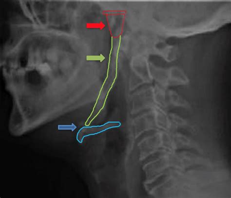 Lateral View Of Neck Demonstrating Styloid Chain Ossification Styloid