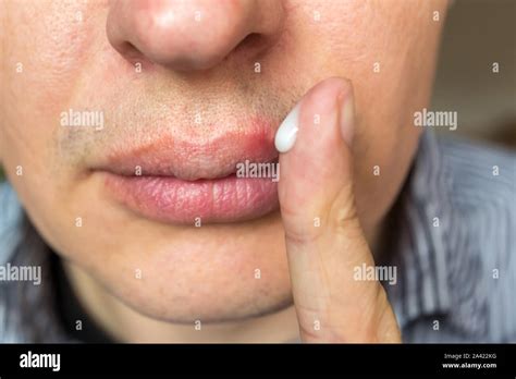 Herpes zoster virus Fotos und Bildmaterial in hoher Auflösung Alamy