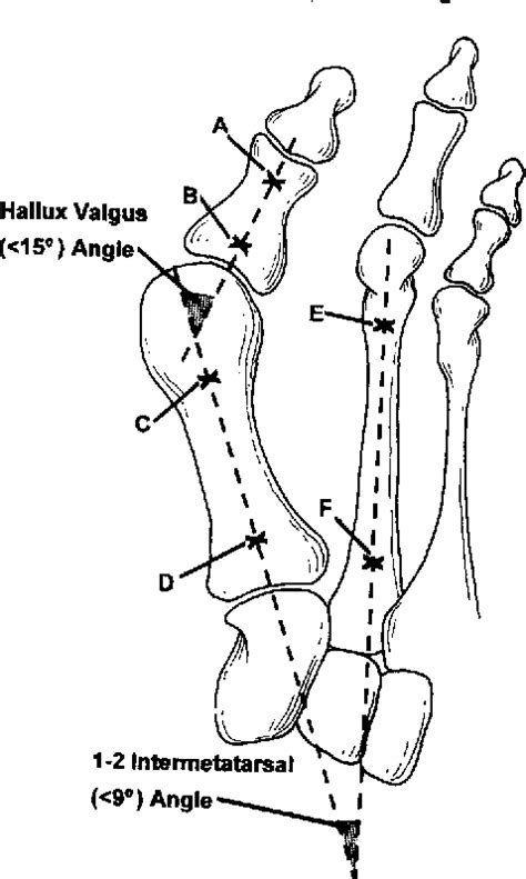 Hallux Valgus Correction Semantic Scholar