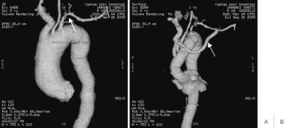 repeat operation  pseudoaneurysm  left ventricular outflow