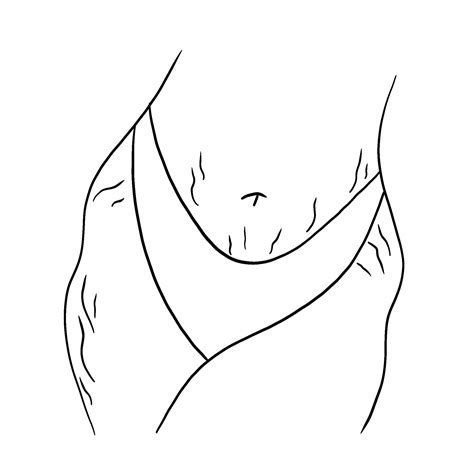 Stretch marks line art – Artofit