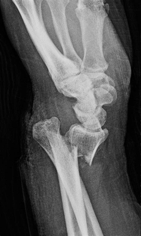 Fracture Of The Distal Radius Epidemiology And Premanagement