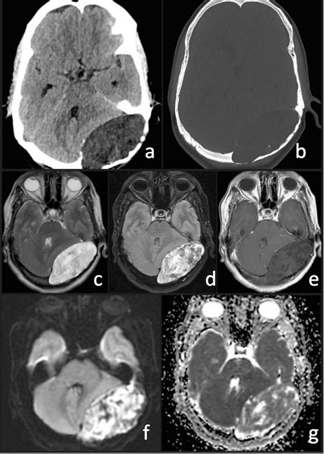 Ndex Fig A Axial Soft Tissue Window Contrast Enhanced Ct Showing Download Scientific Diagram