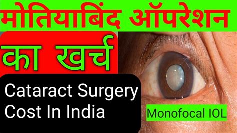 मोतियाबिंद ऑपरेशन का खर्च।cataract Surgery Cost In India।type Of