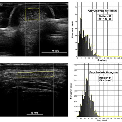 A Transverse B Mode Ultrasound Image Of The Achilles Tendon With