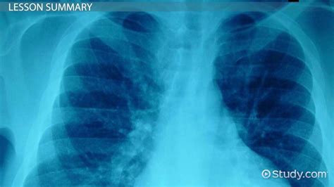 Hemothorax: Definition, Symptoms & Treatment - Video & Lesson ...