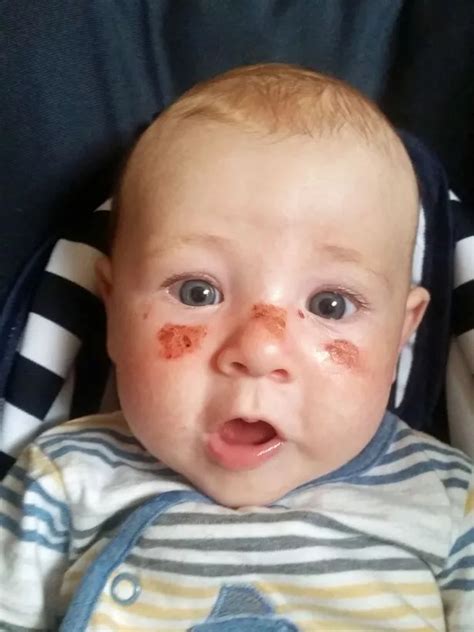 Four Month Old Baby Left With Blisters On His Swollen Face After