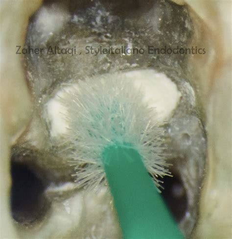 Perforation repair: step by step - Style Italiano Endodontics