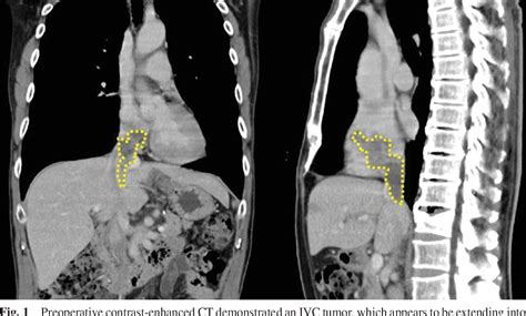 Figure 1 From Complete Resection Of A Cavoatrial Metastatic Liposarcoma