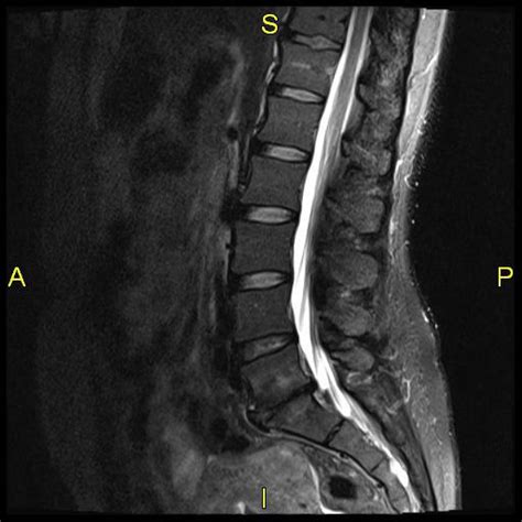 The Best Portland 3T MRI | Why 3T MRI for Spine Imaging?