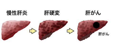 肝がんの特徴・症状とは？｜知る｜エーザイの肝疾患サポートサイト～つなぐ支えあう”あなたらしさ”を～