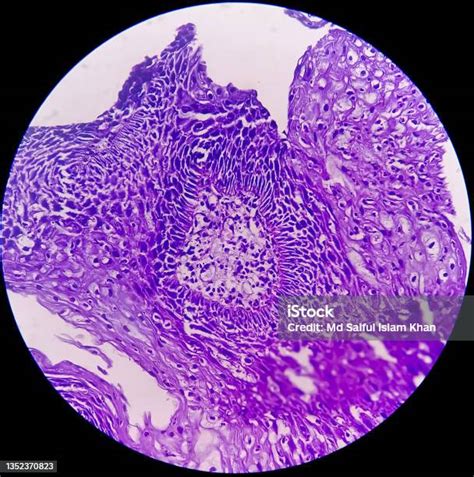 Colon Cancer Photomicrograph Of Colonic Adenocarcinoma Light Microscope 40x Showing Colorectal