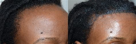 Forehead Reduction Surgery photos | Miami, FL | Patient58682