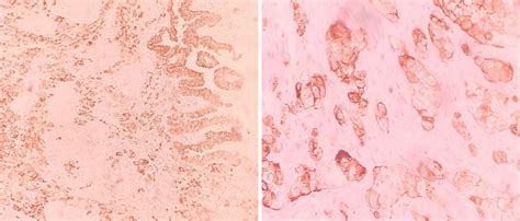 Photomicrograph Showing Tumor Cells Diffuse Positivity For Ck By Ihc