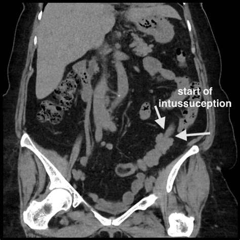 Distal Colocolic Intussusception Due To Lipoma Epiploic Appendagitis Image