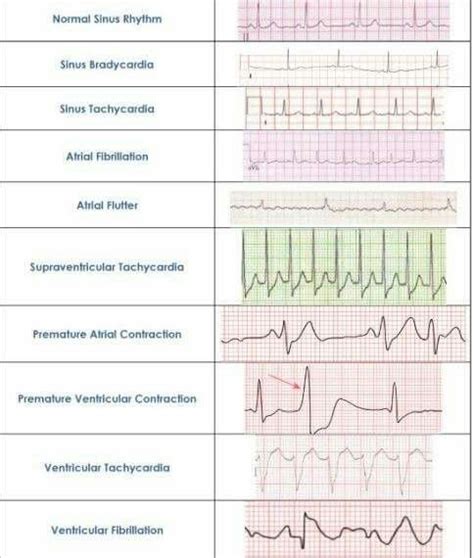 Ekg Cheat Sheet Ekg Interpretation Cheat Sheets Ekg Interpretation Ekg