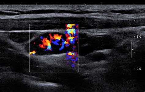 VIETNAMESE MEDIC ULTRASOUND: CASE 435: CERVICAL LYMPH NODES, Dr PHAN ...