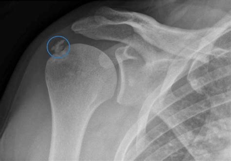 Figure 2 From A Closer Look At A Case Of Calcific Tendonitis Of The