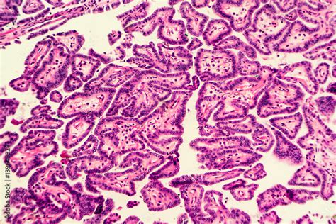 Papillary Thyroid Carcinoma