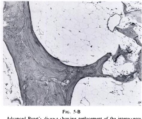 Figure 5 From Osteolytic Form Of Pagets Disease Semantic Scholar