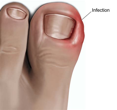 Surgery For Ingrowing Toenail Adult Healthdirect