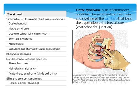 Chest wall syndrome symptoms. Chest Wall Syndrome: Symptoms, Causes ...