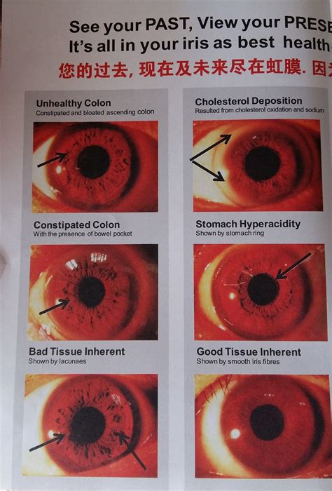 Iridology Diagnosis Of Past Present And Future Illness From The Iris