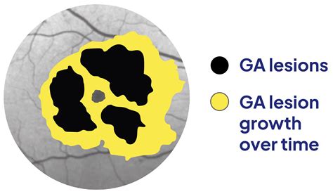 About Geographic Atrophy Ga