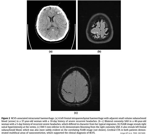 Reversible Cerebral Vasoconstriction Syndrome (RCVS) - EMCrit Project