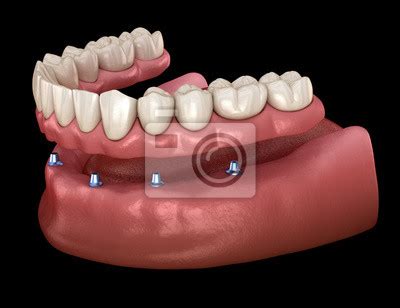 Prótese mandibular tudo em 6 sistemas suportados por implantes