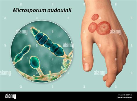 Infección Micótica En La Mano De Un Hombre Ilustración Conocida Como Infección Por Tiña O Tiña