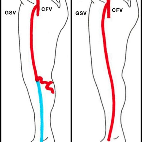 Femoral Vein FV Re Entry Perforating Vein RP And Great Saphenous