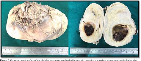 Figure From Large Retroperitoneal Schwannoma A Rare Case Report