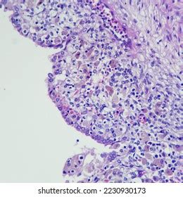 Camera Photo Endometriotic Cyst Showing Endometrial Stock Photo ...