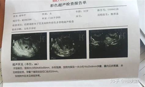 孕晚期B超检查这3个数据要看清楚关系到你能否顺产 知乎