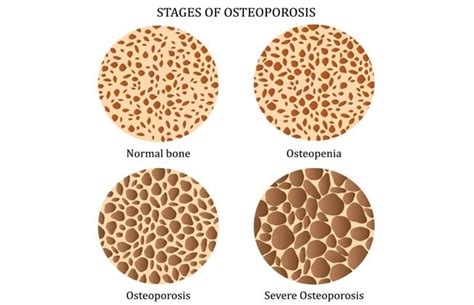 ¿qué Es La Osteopenia Y Cuál Es Su Tratamiento