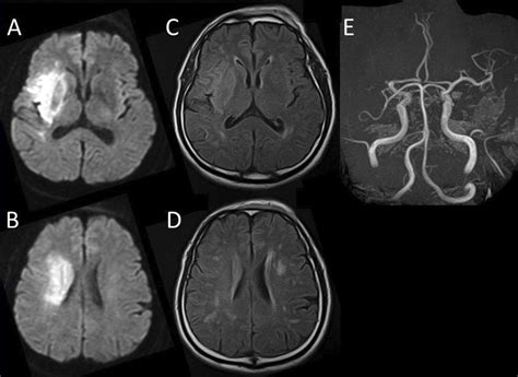 Figure And Table A Case Of Two Stage Surgery Using Intracranial