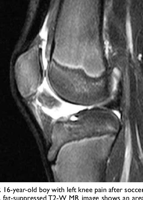 Sagittal Fat Suppressed T W Mr Image Of The Left Knee Of A Year Old