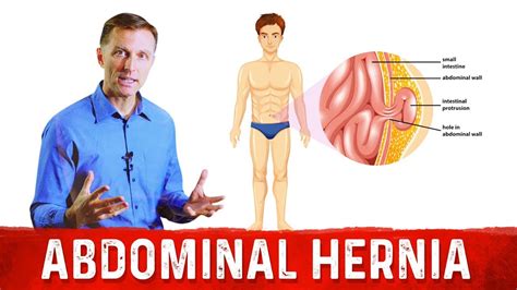 What Causes An Abdominal Hernia Dr Berg On Hernia Causes Youtube