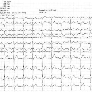 Twelve-lead standard electrocardiogram. Normal sinus rhythm ...