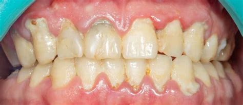 Periodontitis Symptoms Causes And Treatments