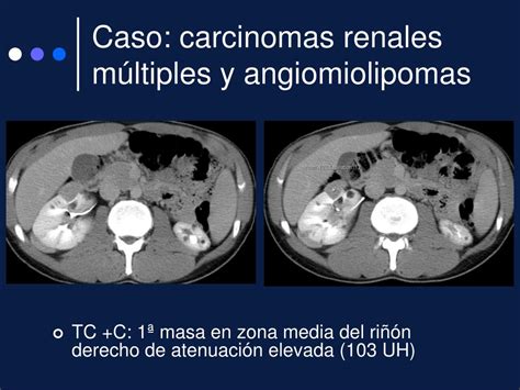 Ppt El Tcmd En El Diagn Stico De Los Tumores Renales M Ltiples